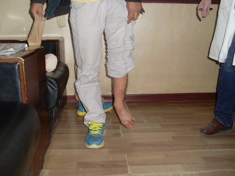 畸形腿、長(zhǎng)短腿(圖1)