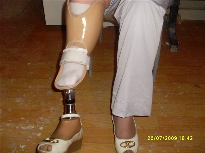 畸形腿、長短腿-2(圖1)